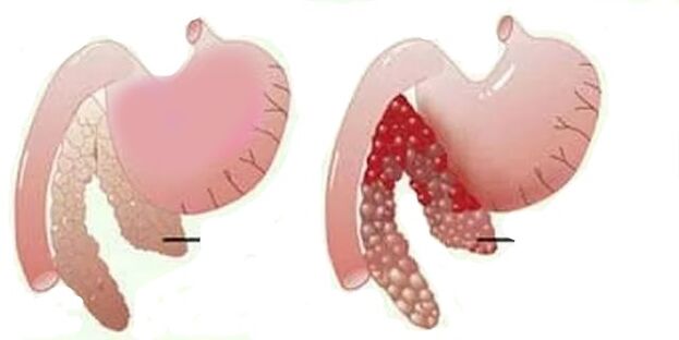 ជំងឺរលាកលំពែង